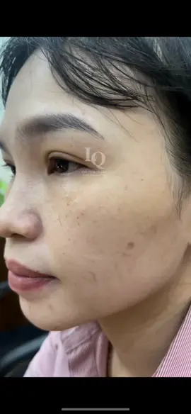 Cập Nhật da tàn nhang #chamsocdamun#chamsocdaseo#chamsocdanam#tanbinh#govap       