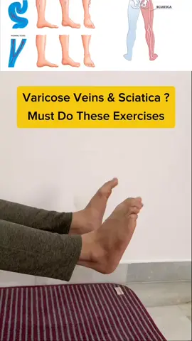 # MUST DO EXERCISE Varicose veins & Must Do These Exercise Step 1 1 Min daily 2 15×3 Sets 3 2 Min daily 4 20×3 Sets 1 Min daily #viralvideo #viraltiktok #100 k follower #foryoupage @tiktok creators 
