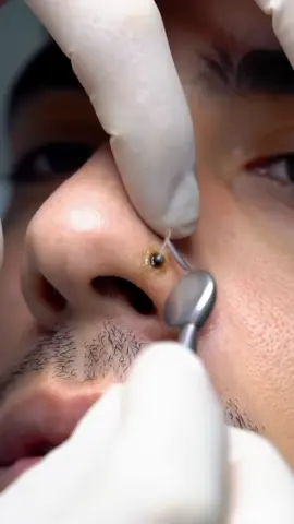 #blackhead #tweezers #skin #extraction #pimples #blackheadremoval #acne #removal #viralvideo #blackheadextraction 