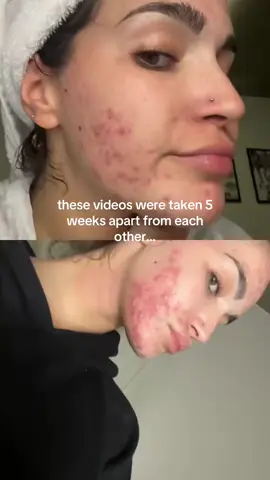 lmk if yall want a storytime because getting laser was the biggest regret of my life #acneskin #storytime #acne #skintok 