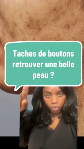 Taches brunes causé par les boutons ! Voici leurs causes comment les traiter #taches #melasma #tik_tok #foryou 