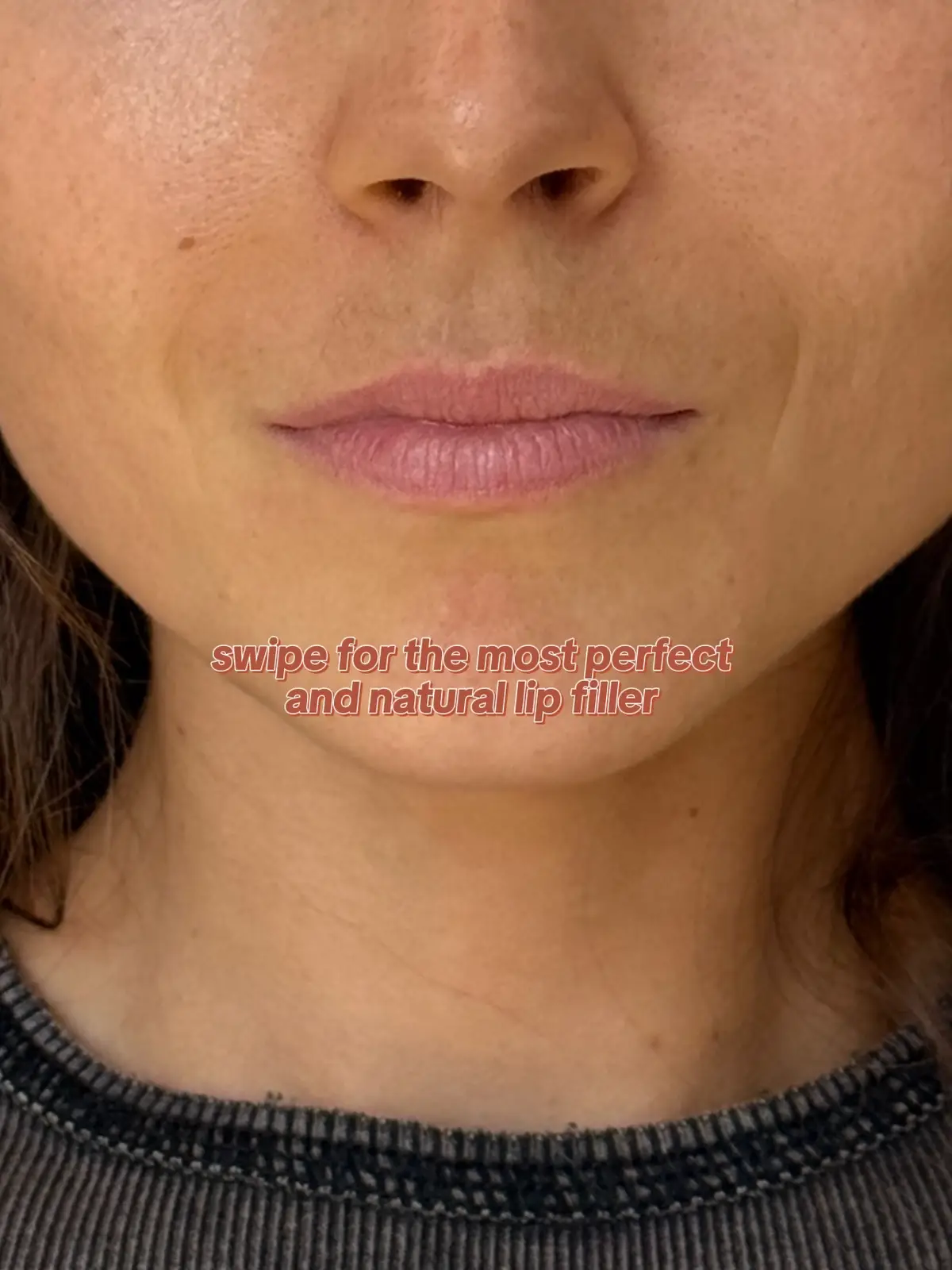 @Velour Medical #lipfiller #naturalresults #lipinjections 