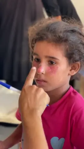 We cannot stop the spread of contagious skin conditions but we can try to mitigate their effects. The occupation has bombed over 500 schools sheltering internally displaced people over the course of the last 22 months. This has only lead to further overcrowding of existing shelters that need to continuously add more people who are displaced. Our North medical teams addressed these concerns during our Medical Days for dermatological issues. On August 5, Translating Falasteen (@translating_falasteen) x The Sameer Project held such a Medical Days at al-Kulliyya Camp in the al-Mukhabarat area in Gaza City. We treated at least 150 children, mostly seeing scabies, fungal rashes, bacterial infections, and “heat rash” from the mixture of warmer temperatures causing sweat and the lack of hygiene products.  Thank you for supporting our Medical Campaign.