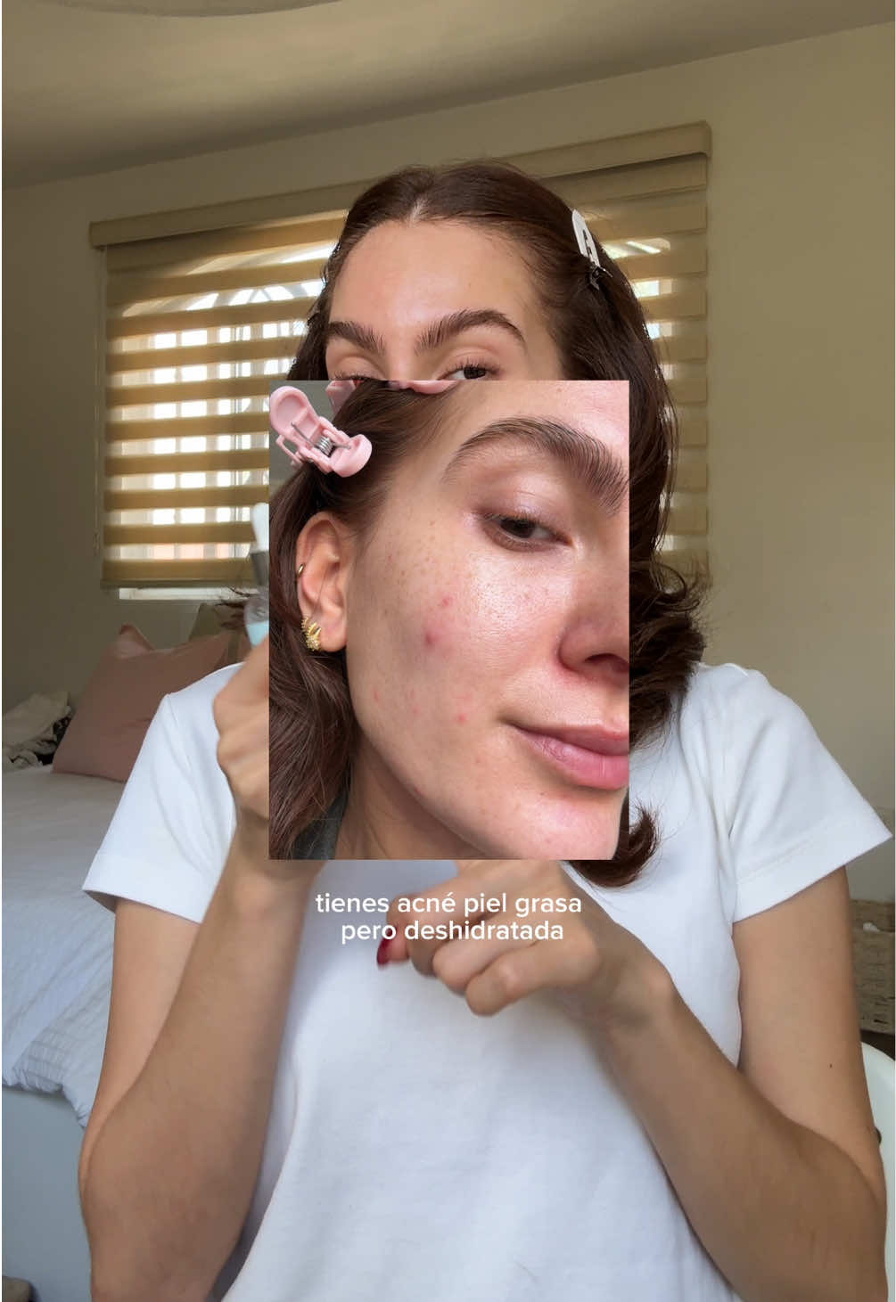 suero hidratante fungal acne safe 🗣️!!! lo puedes encontrar en amazon us (20% off con el code MCRTMA20IUNK válido hasta el 15 de sept) #iunikhydrationserum #iunikbetaglucan #betaglucan #iunik #barrier