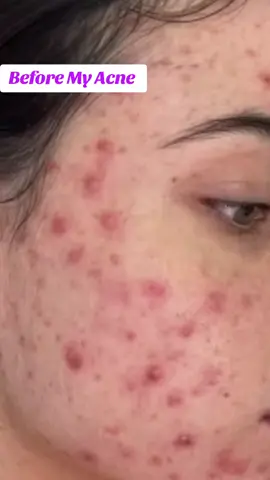 Before and After my Acne Face journey 😧😱#kojictoner #fyp #zuwacosmetics #foryoypage #AffiliateMarketerModeOn💁✨❤️ #poresserum #Kojictoner #sophiaset 