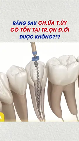 Tuổi thọ của răng sau điều trị tuỷ là bao lâu? #dieutrituy #viemtuy #chuatuyrang #LearnOnTikTok #saurang 