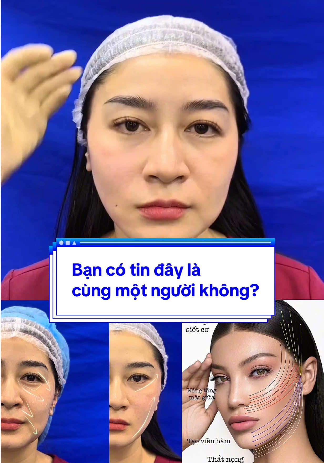 ✨ Một bên mặt đã căng chỉ – gọn gàng, trẻ trung hẳn ra. 😮 Bên còn lại thì vẫn nhão, xệ, kém tươi. ➡ Bạn muốn bên nào? #TreHoaFullFace #cangchi #lamdep #nangtangmatgiua #chiasexuhuong 