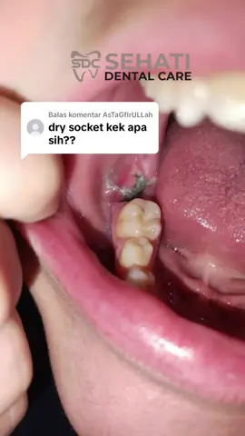 Membalas @AsTaGfIrULLah  Kurang lebih begini dan begitu #drysocket #cabutgigi #fyp #doktergigipadang 