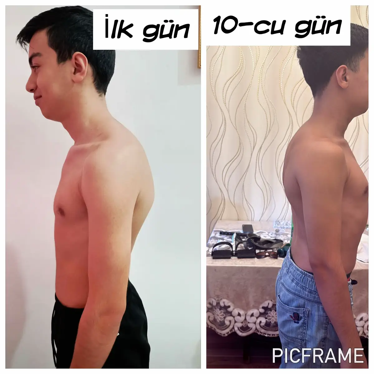 Keskin Kifoz problemi olan Bala’mız