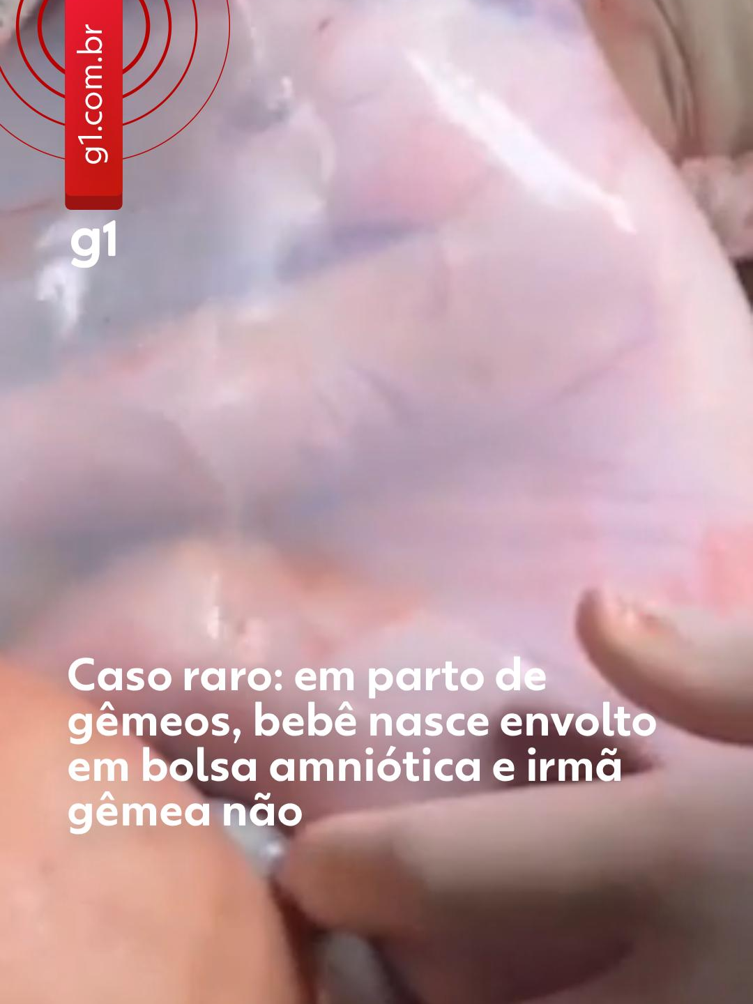 Raríssimo - Um parto empelicado, quando o bebê nasce envolto pela bolsa amniótica, já é considerado raro pelos médicos e chama a atenção de quem presencia. Mas em um caso ainda mais raro ocorrido na Bahia, uma mãe deu a luz a gêmeas com apenas uma das crianças protegida pela estrutura. Olívia e Amelie nasceram em uma clínica particular da cidade de Irecê, no norte do estado, na terça-feira (12). As bebês chegaram ao mundo em uma cesariana que durou cerca de 40 minutos.  A bolsa amniótica é composta por uma película fina e transparente. É quando ela estoura que, normalmente, há a sinalização de que a criança está prestes a nascer. Quando o líquido amniótico vaza, a mãe entende que o parto se aproxima. Contudo, quando a bolsa não se rompe, acontece o chamado parto empelicado, sem riscos para mãe ou para o bebê.  Olívia nasceu com 2,400 kg e 47 cm, e Amelie com 2,654kg e 49cm. As meninas são saudáveis e seguem internadas na clínica. A previsão é de que elas tenham alta nesta quinta-feira (14). Para saber mais, clique em 'leia o artigo' #g1 #tiktoknotícias #partoempelicado #bolsaamniótica #irecê #bahia