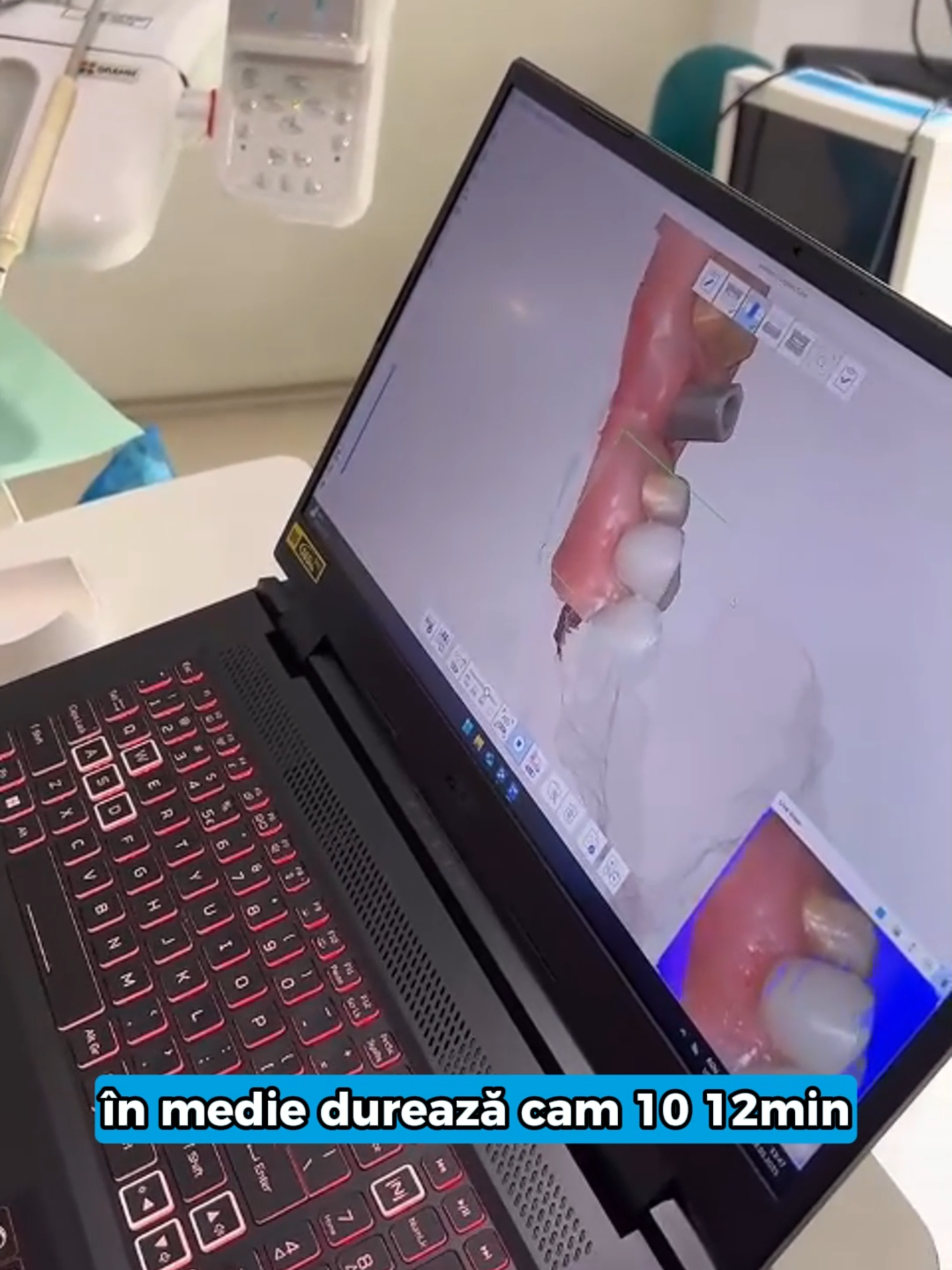 🦷 Scanarea digitală – confort, precizie și rapiditate pentru pacienții noștri 💙 „În ultimul timp, de când am implementat scanările digitale la Denta Clinic, experiența pacienților s-a schimbat complet. 📍 Nu mai există disconfortul amprentelor clasice cu materiale care provocau senzație de greață. 📍 Scanarea este relaxantă, precisă și durează doar 10–12 minute pentru ambele arcade (maxilar și mandibulă), inclusiv verificarea mușcăturii. 🔹 Cum funcționează procesul: Pregătim pacientul și montăm depărtătorii speciali pentru buze, ca scanarea să fie mai ușoară. Datele sunt trimise direct către laborator. Lucrarea provizorie este realizată la imprimantă 3D exact după scanare, iar pacientul o poate proba imediat. Dacă totul este perfect (în 99% dintre cazuri este), trecem la lucrarea finală, care se poate realiza în maximum 2 zile. 💬 Ținem cont întotdeauna de preferințele pacientului – lungimea, culoarea și forma dinților – pentru ca rezultatul final să fie nu doar funcțional, ci și estetic, perfect adaptat personalității fiecăruia. ✅ La Denta Clinic, punem accent pe fiecare detaliu pentru ca tu să te bucuri de o dantură fixă funcțională și estetică, care să dureze o viață întreagă. 🦷 Dantură Fixă pe Implanturi fără durere, cu tehnologii moderne și tratamente personalizate. 🔍 Vezi testimoniale video și scrise aici: https://shorturl.at/iCp4M 🎯 Intră în grupul nostru de suport și discută direct cu pacienți sau medici: https://www.facebook.com/groups/240577866975450/ 💬 Consultație GRATUITĂ + ghidare completă în alegerea celei mai bune soluții. 📍 Calea București 193A, Râmnicu Vâlcea 📞 WhatsApp: +40 761 233 220 🌐 www.dentaclinic.ro 🔗 Toate resursele utile: linktr.ee/dentaclinic.vl #DentaClinic #ScanareDigitală #StomatologieModernă #FărăDurere #Tehnologie3D #ImplanturiDentare #ZâmbetPerfect