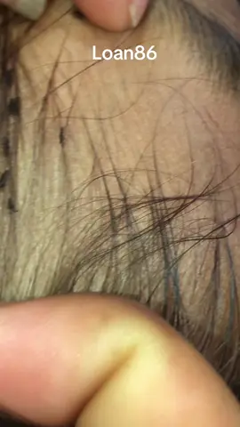 #lice #omg #liceremoval #😱😱😱😱😱😱😱😱😱😱 