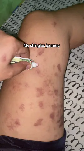 2 weeks shingles #zudaifuointment #ointmentsakatikati #ointmentforrashes #skinallergies #rashes 