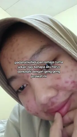 padahal anak² seumuranku sedang menikmati centil era mereka, pake make up, skincare viral, dll tapi aku malah sebaliknya #acnefighter #acneprone #womensupportwomen 