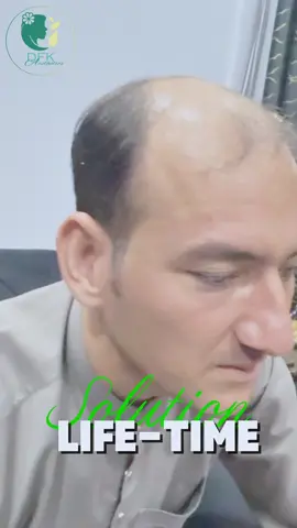 Lifetime Solution by Dr Fareed Ullah Khan #hairtransition #FUEHairTransplant #HairLossSolution #DermatologistPakistan #rawalpindi #AestheticClinicPK #HairRestoration 