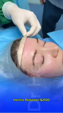 Lower your hairline and lift your forehead to give your face a golden ratio. #hairrline #face #usa🇺🇸 #drhan 