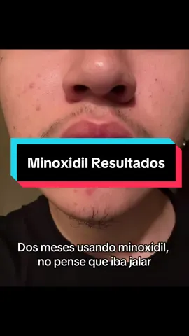 Ya mero 🫡 #minoxidil #beard #minoxidilresult #minoxidilbeard #beardgrowth #barba
