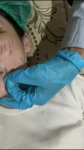 akupuntur facelift  Akupuntur wajah home service lagi,...🥰 Manfaat akupuntur facelift  *mengencangkan wajah *meningkatkan elastisitas   kulit wajah *mengurangi dauble chin *merangsang colagen secara alami *menghilangkan kantung mata (bertahan secara alami) *menggurangi kerut halus diwajah *mengecilkan pori-pori *menstabilkan hormon,mengatasi jerawat membandel *Menghilangkan flek (bertahan secara alami) *Memperlancar peredaran darah sehingga wajah tampak cerah merata  Yuk mulai perawatan di mifta akupuntur facelift dan bisa home servis ya best 🥰 Reservasi di 085713548339 #akupunturwajahhomeservis #akupunkturwajah #akupunturkecantikan #akupunturfaceliftjakarta #akupunturfaceliffhomeservis