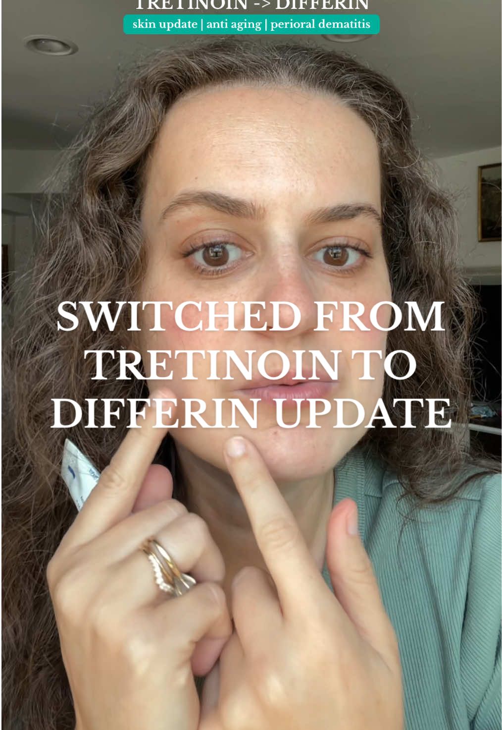 now what?!?! 😅 not the update i hoped to give after switching from tretinoin to differin gel - dealing w/ perioral dermatitis yet again :( #tretinoin #differin #perioraldermatitis #retinoid #tretinoinjourney 