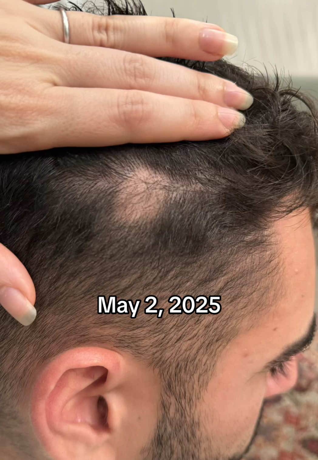 This is about 3 months of consistently using the bundle 🙌🏼 . . . . . #hairgrowth #hairloss #baldspot #hairgrowthjourney #rosemaryoil 