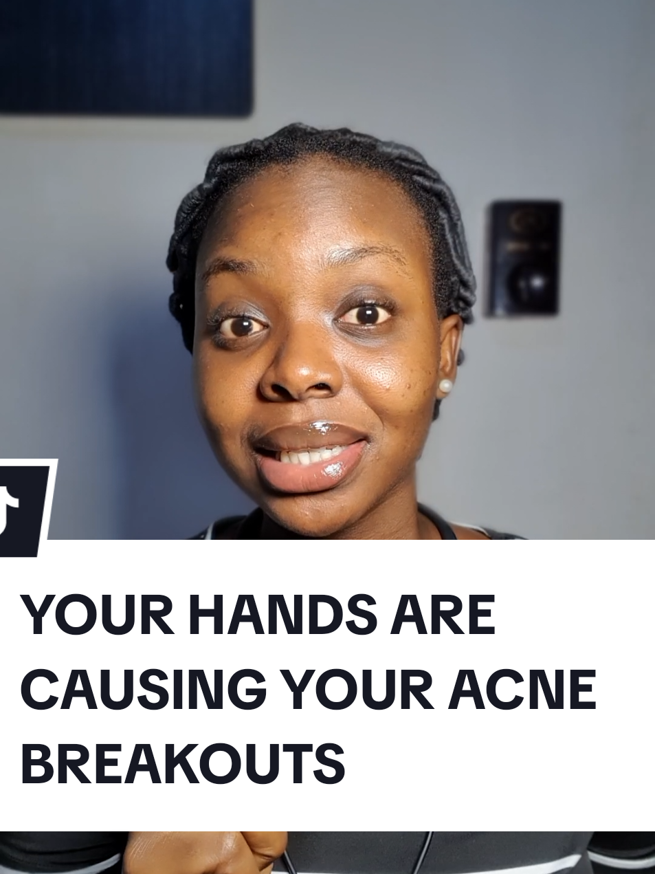 How your hands are causing your acne breakouts #skincarerecommendation #velmariskin #skincaretip #pimplesolution #skincarecommunity 