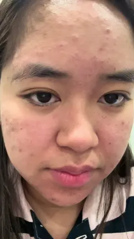 Sa dami kong natry🥹 Eto talaga eto lang pala makakapag pa ayos ng face ko😭😍