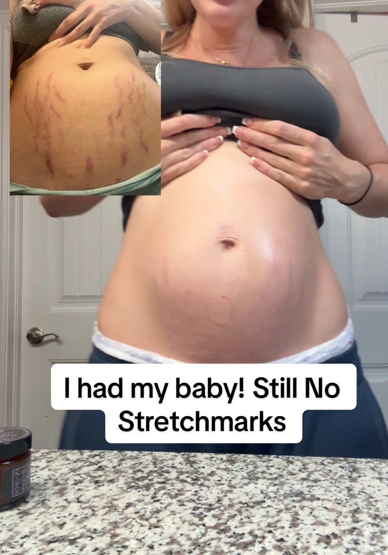 3 days postpartum, at home with my newborn — and finally sharing the stretch marks everyone’s been asking about. This is the real, unfiltered side of birth recovery that we don’t see enough. Every mark tells the story of my baby’s journey earthside. 💗  Disclaimer: Based on my personal experience. For informational purposes only and not medical advice. Always consult your qualified health provider regarding your own postpartum care. #postpartumstretchmarks #homebirthstory #postpartumbody #stretchmarkjourney #MillennialMoms