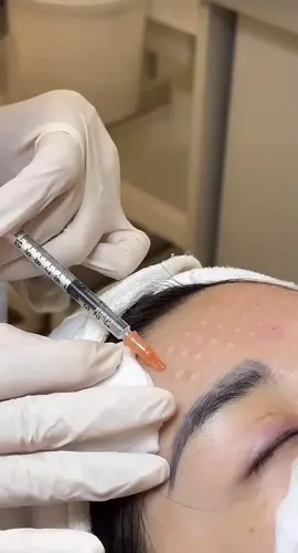 Tiêm Meso hay tên đầy đủ là Mesotherapy, là một thủ thuật thẩm mỹ không phẫu thuật. Phương pháp này sử dụng các mũi kim siêu nhỏ giúp đưa các loại dưỡng chất, vitamin, enzym, chất chống oxy hóa,... vào lớp trung bì của da, nơi các tế bào da cần chúng nhất, giúp chúng hấp thụ tốt hơn so với việc bôi thoa ngoài da.