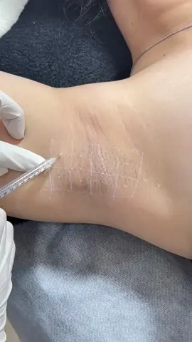 Dịch vụ hot hit cho mùa nắng nóng, botox vùng nách #botox #tuyenmohoi 