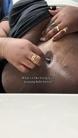 When they ask what it’s like living with a draining belly button… I wish I could tell them it’s just an inconvenience. But it’s more than that — it’s pain, it’s smell, it’s constant care, it’s waking up soaked, it’s cleaning wounds when all you want is sleep. It’s never knowing when it will stop or when it will start again. It’s wearing the right clothes to hide the stains, carrying supplies everywhere you go, and trying to smile while you’re silently hurting. This is life with Hidradenitis Suppurativa & PASH. 💜 #JustHowLifeGoes #HSWarrior #HidradenitisSuppurativa #ChronicIllnessLife #PASHWarrior 