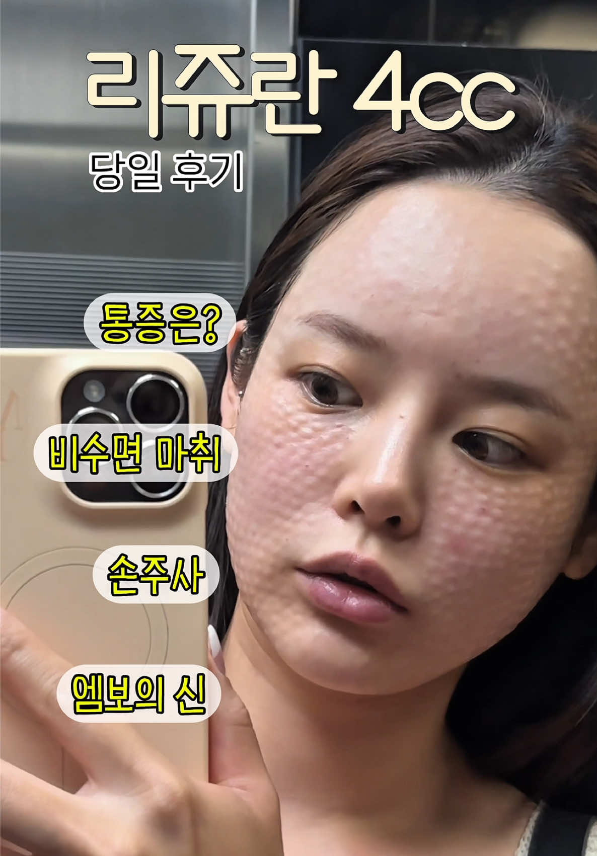 #리쥬란 4cc 후기‼️ 리쥬란은 제가 처음 맞아봤어요 이게 그렇게 효과가 좋다고 소문이 자자 하더라구요? 오늘은 리쥬란 당일 후기! 2찬 후기도 빠르게 가져올게요💕 #리쥬란후기 #스킨부스터 #피부관리 #피부시술 