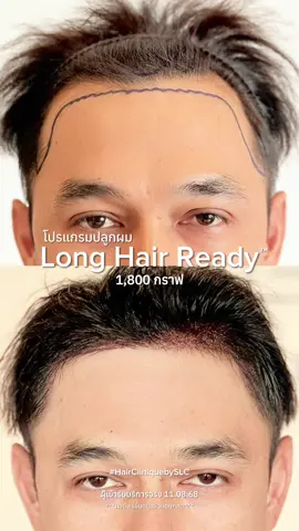 ผู้ชายเดี๋ยวนี้เค้าดูแลตัวเองดีมากค่ะ! 😉✨ #รีวิวปลูกผมHairClinique #HairCliniquebySLC #BeYourBestSelf #คลินิกดูแลเส้นผม #รีวิวปลูกผมSLC             