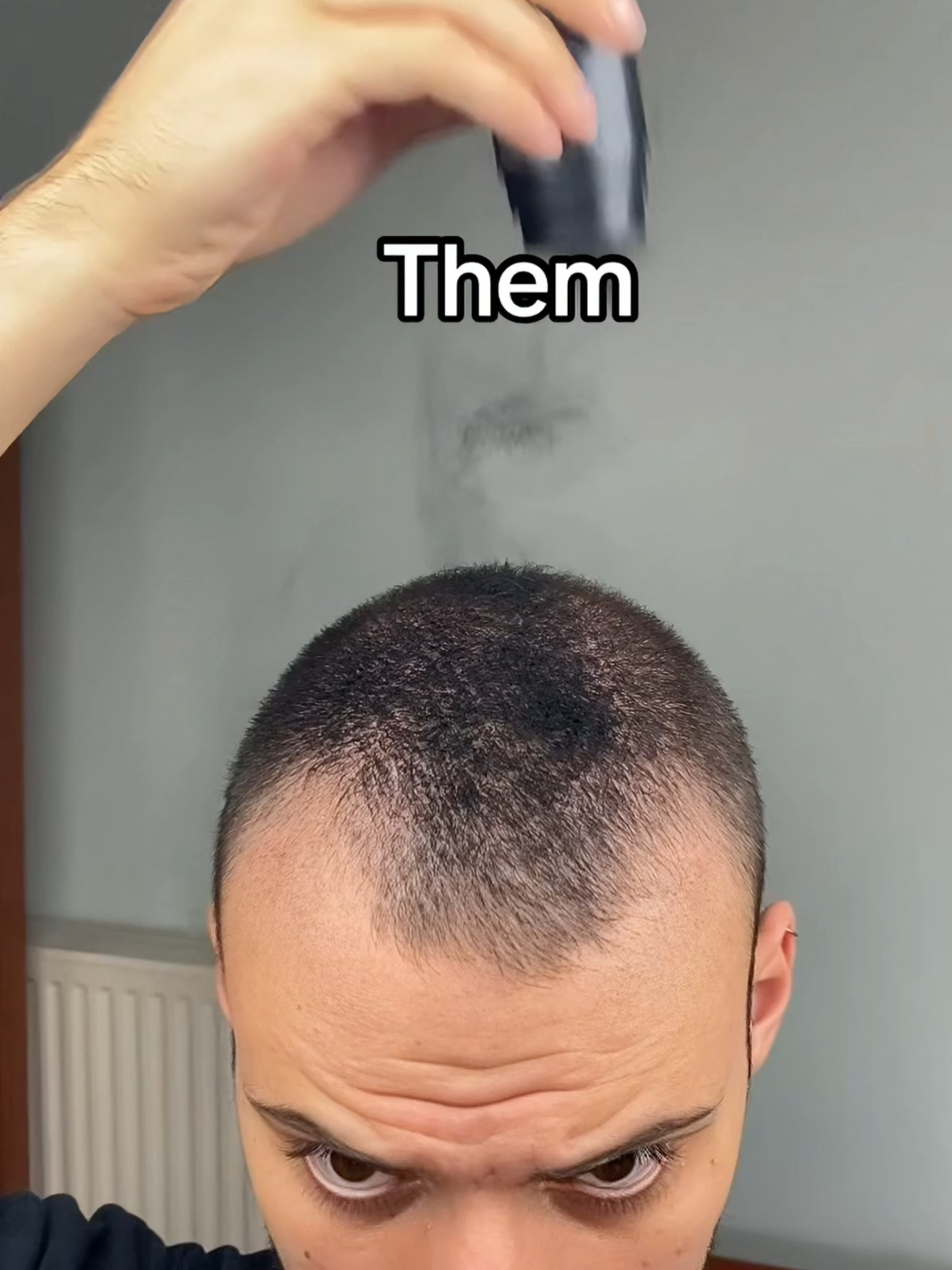 HAIRLINE GONE? ✨ INSTANT CONFIDENCE BOOSTER!##2025 #singaporehairsalon #haircolour ##baldspot #menshairloss #50off #waterproofmakeup #baldtransformation #HairTok #instanthairmagic #fyppppppppppppppppppppppp