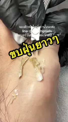 ขบฝุ่น ขนยาวๆ😅    💓 #namthipnails #ตัดเล็บขบ #ตัดหนัง #ทำเล็บ#ทําเล็บดเล็บขบ      