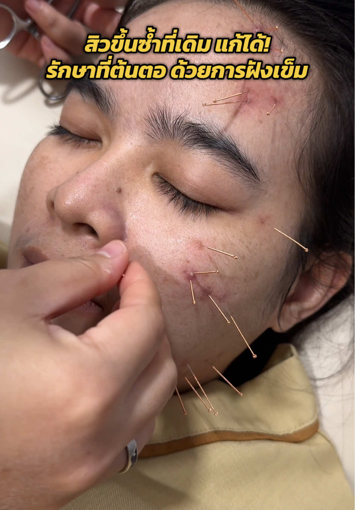 สิวที่ขึ้นซ้ำๆ บอกอะไรเรามากกว่าที่คิด  #สิว #ฝังเข็มหน้าใส #หน้าใส #ฝังเข็ม #แพทย์แผนจีน 
