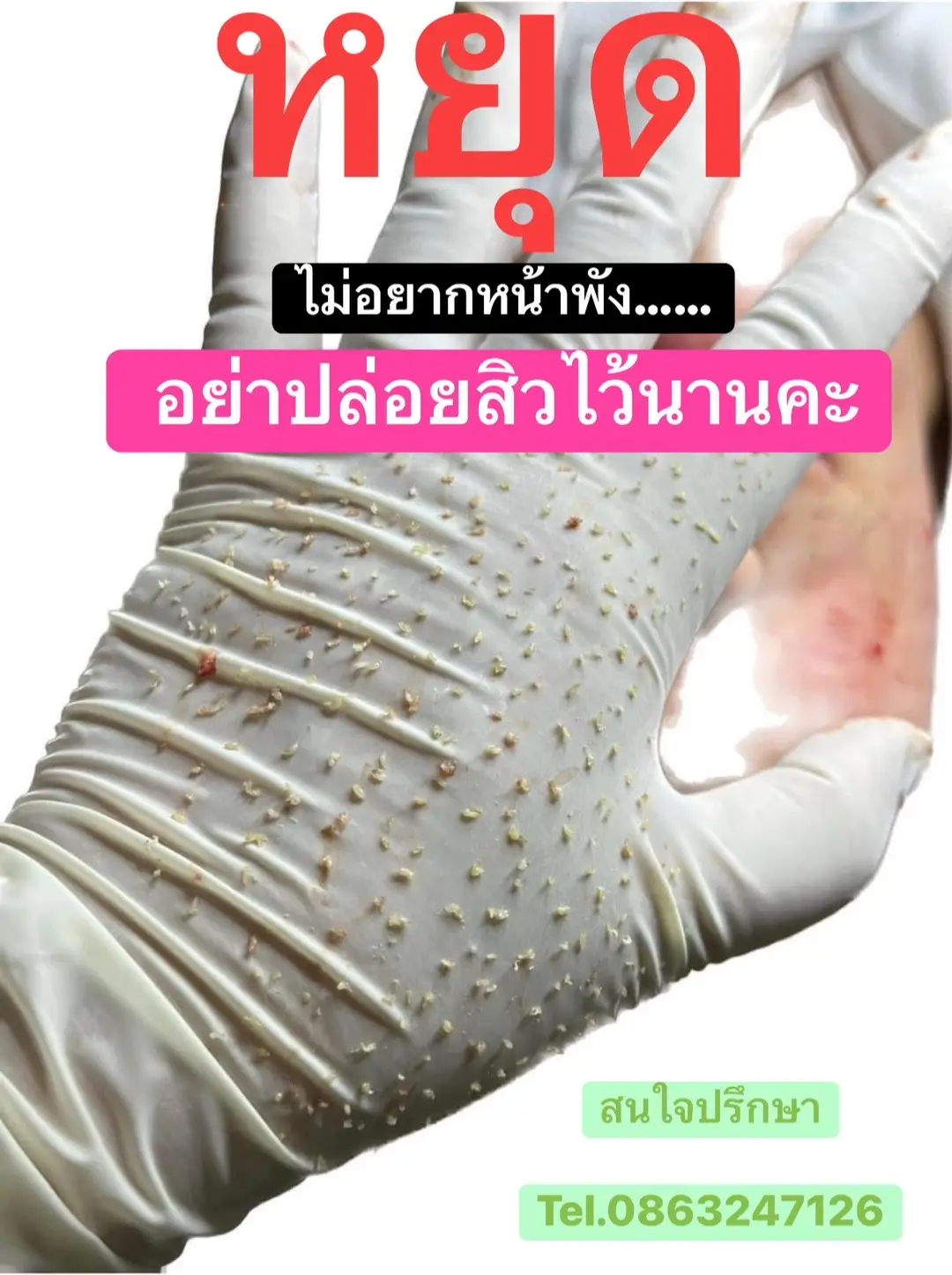 เมื่อเริ่มเป็นสิวอุดตัน ถ้าไม่อยากหน้าพัง ให้รีบดูแลผิวหน้านะคะ รีบกดสิวอุดตันออกให้เร็วที่สุด ก่อนที่จะกลายเป็นสิวเกรดที่รุนแรงมากขึ้น การกดสิวต้องทำโดยผู้เชี่ยวชาญและเครื่องมือต้องสะอาด ผ่านการฆ่าเชื้ออย่างถูกวิธี  👉🏻ปรึกษาฟรี ไม่มีค่าใช้จ่าย 💁ปัญหาสิว ฝ้า กระ ริ้วรอย จุดด่างดำ หลุมสิว  สิวจ๋าาาลาก่อนนนนน  บอกลาสิวทั้งหน้าต้องมาที่นี่    ♥️ออเรเดียนท์ สกินแคร์ ที่เรื่อง1สิว♥️ ➡️หลุมสิวตื้นขึ้น รอยสิวจางลง👏👏 ➡️ดูแลสิวอักเสบ สิวหนอง สิวอุดตัน👍👍 ➡️แผลสิวหายไวขึ้น ลดรอยดำ รอยแดง👈👈 ➡️รูขุมขนกว้างกระชับเล็กลง😍😍 ➡️ผิวหน้าขาวกระจ่างใส เรียบเนียน ผิวดูสุขภาพดี [ดูแลผิวหน้าโดยผู้เชี่ยวชาญมีประสบการณ์การด้านดูแลสิวมามากกว่า15ปี] [99% ของผู้ที่รักษาจริง ประทับใจและเห็นผลจริง] --------------------------------------------- 👉🏻สอบถามเพิ่มเติม พิกัด ออลเรเดียนท์ สกินแคร์ ตรงข้ามตลาดสมาร์ทแลนด์ ข้าง รร.บ้านห้วยปราบ ☎️Tel 0863247126 Facebook👉ออลเรเดียนท์สกินแคร์ ⏳เวลาทำการ :จันทร์-อาทิตย์  10.30-20.30