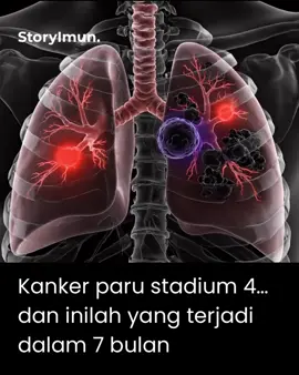 ✨ “Hidup Saya Ajaib” — Dari Vonis Beberapa Bulan ke Hidup Bebas Kanker ✨ Dena Guidice, seorang pasien kanker paru-paru stadium 4 yang telah menyebar luas, diperkirakan hanya memiliki sisa hidup beberapa bulan. Kemoterapi dan operasi gagal menghentikan penyebaran kanker, dan ia pun pasrah. Hingga pada Oktober 1999, ia memutuskan mencoba terapi imun berbasis molekul imun alami secara intensif. 📅 Perubahan luar biasa: 	•	30 hari: mulai merasa lebih kuat, nafsu makan kembali 	•	90 hari: berat badan naik 12 kg, kondisi tubuh jauh lebih sehat 	•	7 bulan: dokter terkejut — tidak ditemukan tanda-tanda kanker sama sekali Bagi Dena, ini bukan hanya kesembuhan, tapi keajaiban yang mengembalikan harapan untuk menjalani tahun-tahun ke depan. 📊 Fakta medis: Molekul imun terbukti dapat meningkatkan aktivitas sel NK hingga ±437% dan fungsi sel T-helper hingga ±264%, membantu tubuh mengenali dan menghancurkan sel kanker lebih efektif. 📲 Ingin tahu lebih lanjut tentang terapi imunoterapi? Konsultasi via WhatsApp 0812-9752-5790 atau klik link di bio ⸻ #Imunoterapi #TerapiImun #KankerParu #MolekulImun #sembuhkanker     