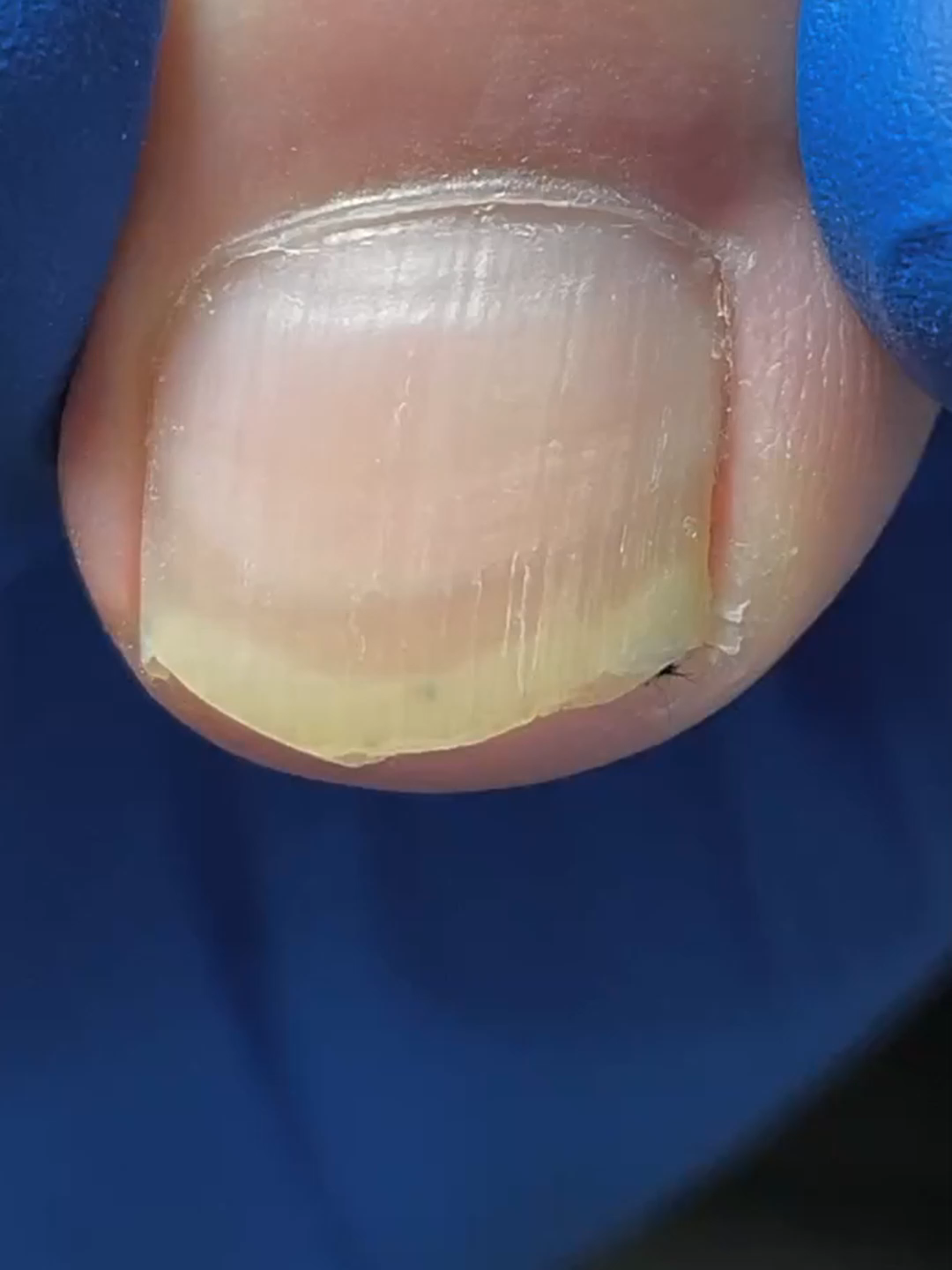 #nails #asmrnailsalon #pedicure #asmr #asmrnails #toecleaning