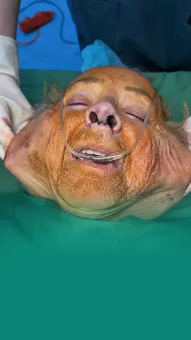 #pttm #cangdamat #facelift #Necklift 🇺🇸🛫🇻🇳 #Nhatha 