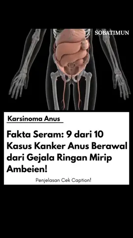 Karsinoma anus adalah kanker ganas yang tumbuh di ujung saluran pencernaan (anal canal). Sering dianggap “wasir biasa”, padahal bisa menyebar ke organ lain dan mematikan jika terlambat ditangani. Faktor risikonya: Hubungan seksual tidak aman (anal sex) Infeksi HPV Riwayat wasir atau luka di area anus Kekebalan tubuh yang lemah 📍 Gejala yang Harus Diwaspadai: 🔸 BAB berdarah (merah segar) 🔸 Benjolan di sekitar anus 🔸 Nyeri saat BAB 🔸 Gatal atau rasa terbakar di anus 🔸 Cairan/lendir keluar dari anus 🔸 Rasa “ada yang mengganjal” di area dubur ⚠️ Bahaya Jika Dibiarkan: ❗ Menyebar ke kelenjar getah bening & organ perut ❗ Sulit duduk/berjalan ❗ Bisa menyebabkan gagal organ & kematian 💬 Ajakan Konsultasi: Jangan tunggu hingga BAB terasa seperti disilet! 📲 0877-7636-2719 — Konsultasi GRATIS & rahasia terjaga #KarsinomaAnus #KankerAnus #fypシ゚ #sobatimun #fyp   