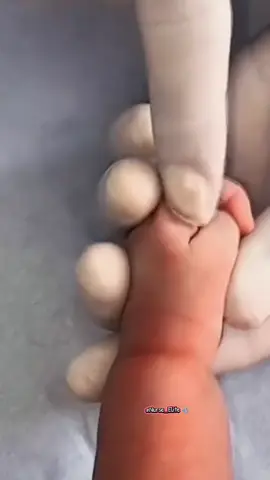 Teknik Insersi IV Cannula Baby🩺 #nurse #education #teknik #skills #infus 