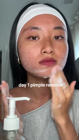 me and my nose pimple have beef bc why is it so big😀 #acne #pimples #acneproneskin #skincareroutine  @Youth To The People superfoods cleanser  @iUNIK beta glucan serum  @byoma toner  @anua_global azeliac acid serum  @Vanicream™ Sensitive Skin Care facial moisturizer  @Estee Lauder Vietnam eye cream  @rhode skin lemontini peptide 