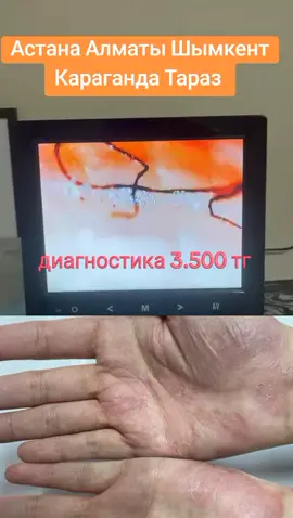 #паразитывчеловеке #паразитыучеловека #паразитоз #лямблии #гельминты #аллергиякаклечить 