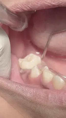 Fixing Proximal cavity with composite restoration #dentist #dental #dentistry #UK 