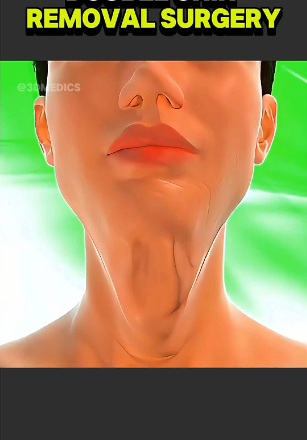 How Double-Chin Removal Surgery Performed? (3D Animation) #doublechinreduction #doublechinremoval #chinlipo #beforeandafter #jawlinetransformation 