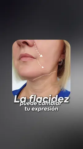 ¿Tu piel ya no luce como antes? Con Morpheus8 combatimos la flacidez y los jowls desde adentro, estimulando colágeno y definiendo el contorno facial. Resultados visibles, naturales y sin cirugía. 📍 Elebelle – Precisión que rejuvenece. #morpheus8 #bellezanatural #lineasdeexpresion #rejuvenecimiento 