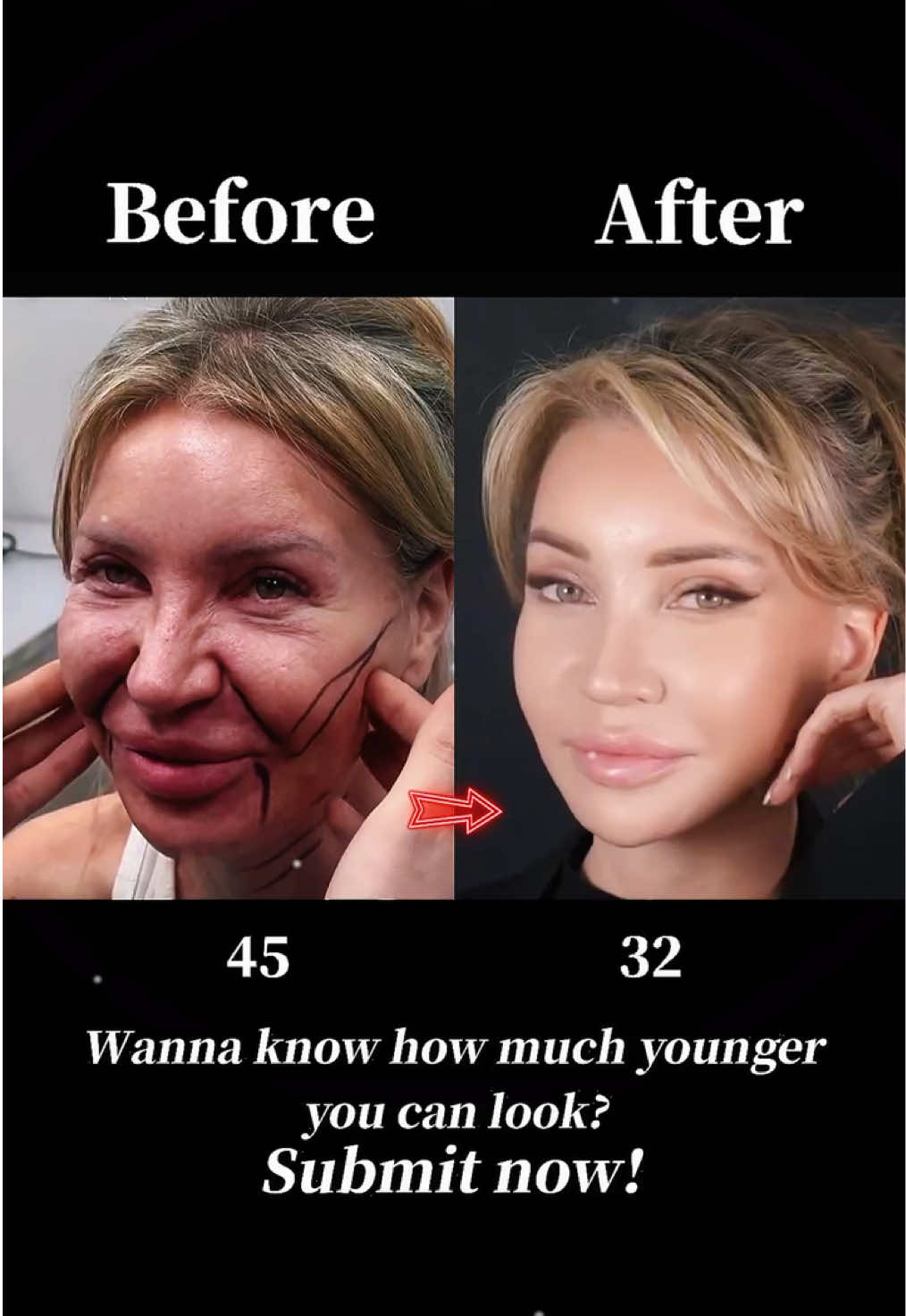 #facelift #antiaging #facelifting #plasticsurgery ‎#تركيز الوجه#拉皮手术 #面部提升 