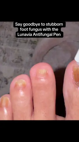 Get rid of stubborn fungus fast with the Lunavia Antifungal Pen. Powered by 25% Undecylenic Acid, it tackles Athlete’s Foot, Jock Itch, and Ringworm at the source. Easy brush-on application, no mess, and visible results in days. 🚚 Free shipping + Buy 1, Get 2 FREE and step into healthy, confident feet today! #Lunavia #AntifungalPen #FootCare #HealthyFeet  #AthletesFootRelief   