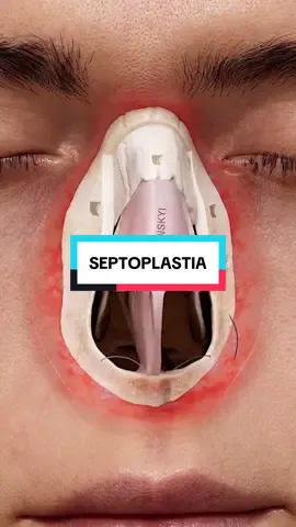 Assim é feita a septoplastia, cirurgia para correção do desvio do septo nasal #medicina #medico #hospital 