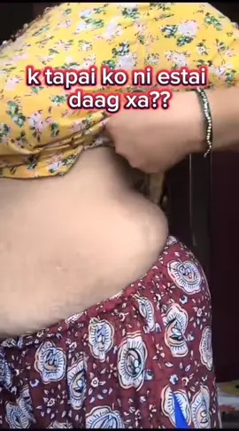 Stretch mark before vs after  9744328302  Guranteee results  #allnepaltiktokgroup🇳🇵 #stretchmarks #beforvsafter #goviral 